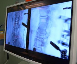 Ponad sto operacji kręgosłupów z udziałem robota w szpitalu wojewódzkim w Szczecinie