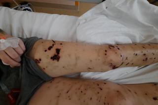 Psy szarpały jej ciało, pozbawiły twarzy. Trwa zbiórka na leczenie 18-letniej Weroniki spod Łasku