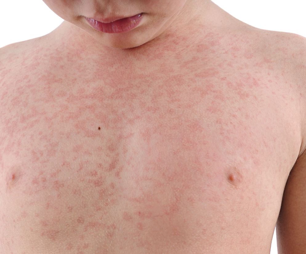 Alergia kontaktowa u dzieci. Jakie są objawy alergii kontaktowej u dzieci?