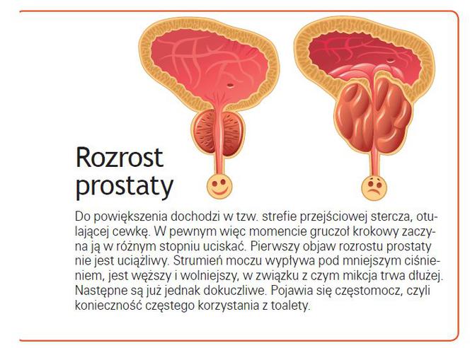 neerhalen Geladen selecteer Łagodny przerost prostaty: leczenie - PoradnikZdrowie.pl