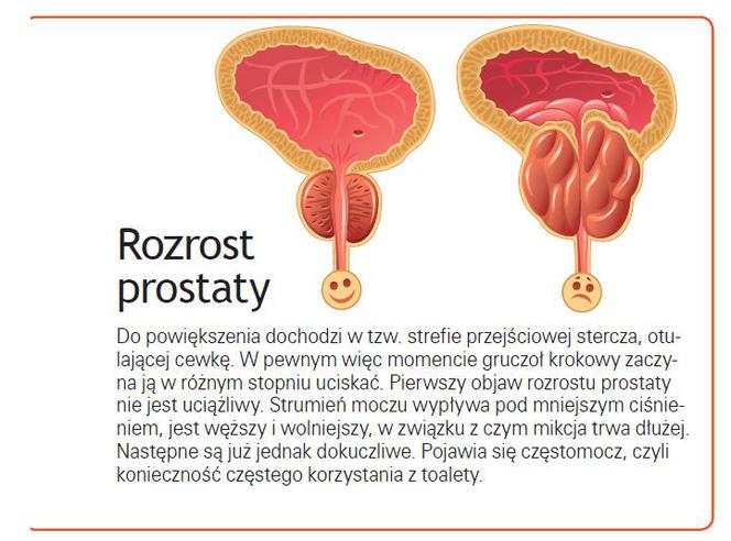 Przerost prostaty