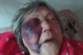  Ogromny krwiak, złamane ząb i oczodół. Opłakany stan seniorki po wyjściu ze szpitala
