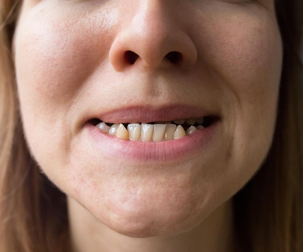 Na dr Smile nabrały się tysiące, nadal za to płacą. Czy można wyprostować zęby bez aparatu?