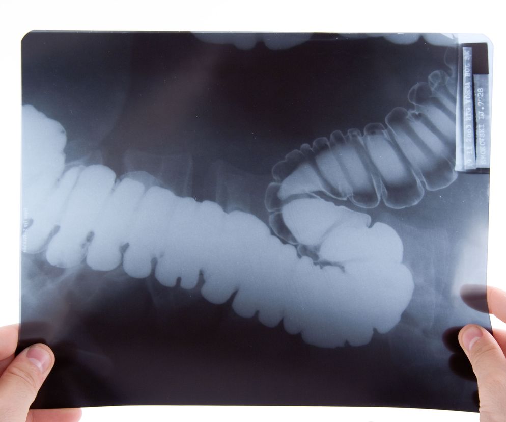 Ostre rozdęcie okrężnicy (megacolon toxicum) to rzadkie, groźne dla życia schorzeniem, powikłaniem zapalenia jelit.