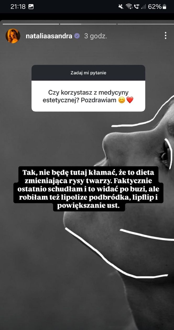 Natalia Zambrzycka (Agata z serialu "Barwy szczęścia") na Instagramie przyznała się, co zrobiła z twarzą! 