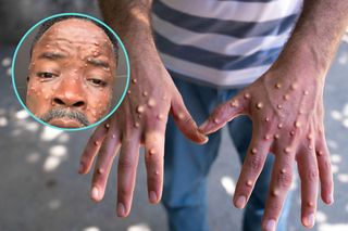 Ponad 500 nowych zakażeń w tydzień! Epidemia ogarnia Afrykę, rządy biją na alarm
