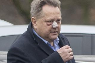Jarosław Zieliński z plastrami na nosie
