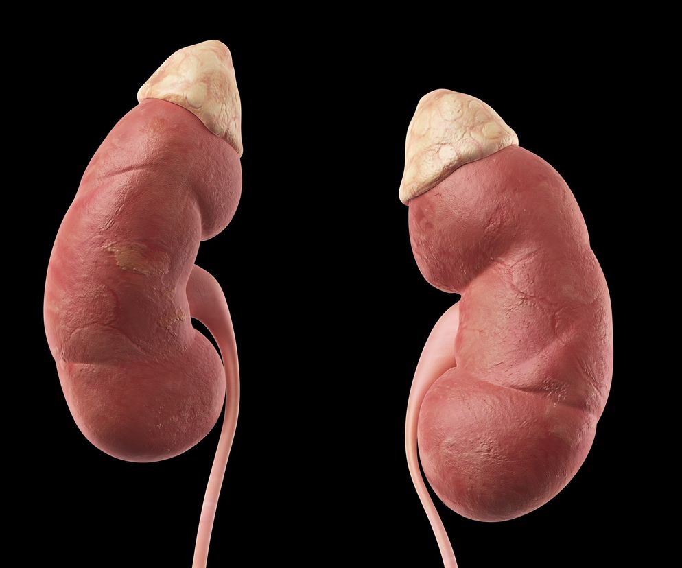 HIPERALDOSTERONIZM pierwotny (zespół Conna) i wtórny. Objawy i leczenie