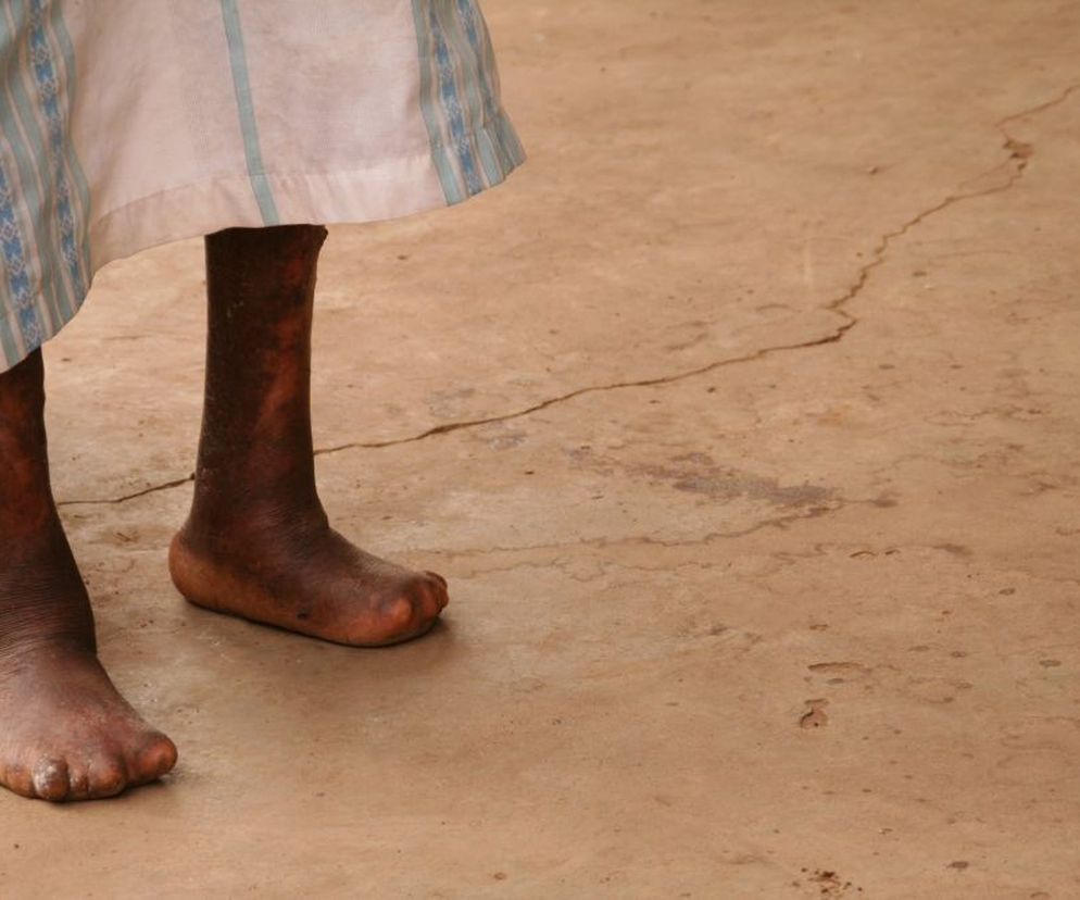 Trąd  to choroba zakaźna, która występuje w krajach klimatu tropikalnego i subtropikalnego