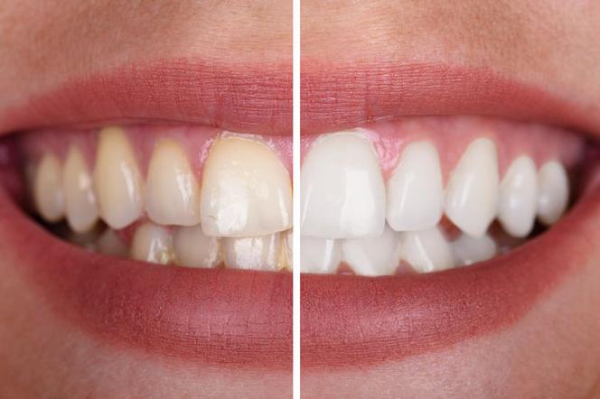 W dzisiejszych czasach są sposoby na wybielanie zębów, które pozwalają na rozjaśnienie ich barwy nawet o 5 i więcej tonów