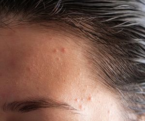 Kosztuje 5 zł, a działa jak oczyszczanie wodorowe za 300. Koniec z wyciskaniem wągrów