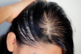 Trycholog pokazała skórę głowy po umyciu popularnym szamponem. To straszne, że wciąż go nadużywamy 