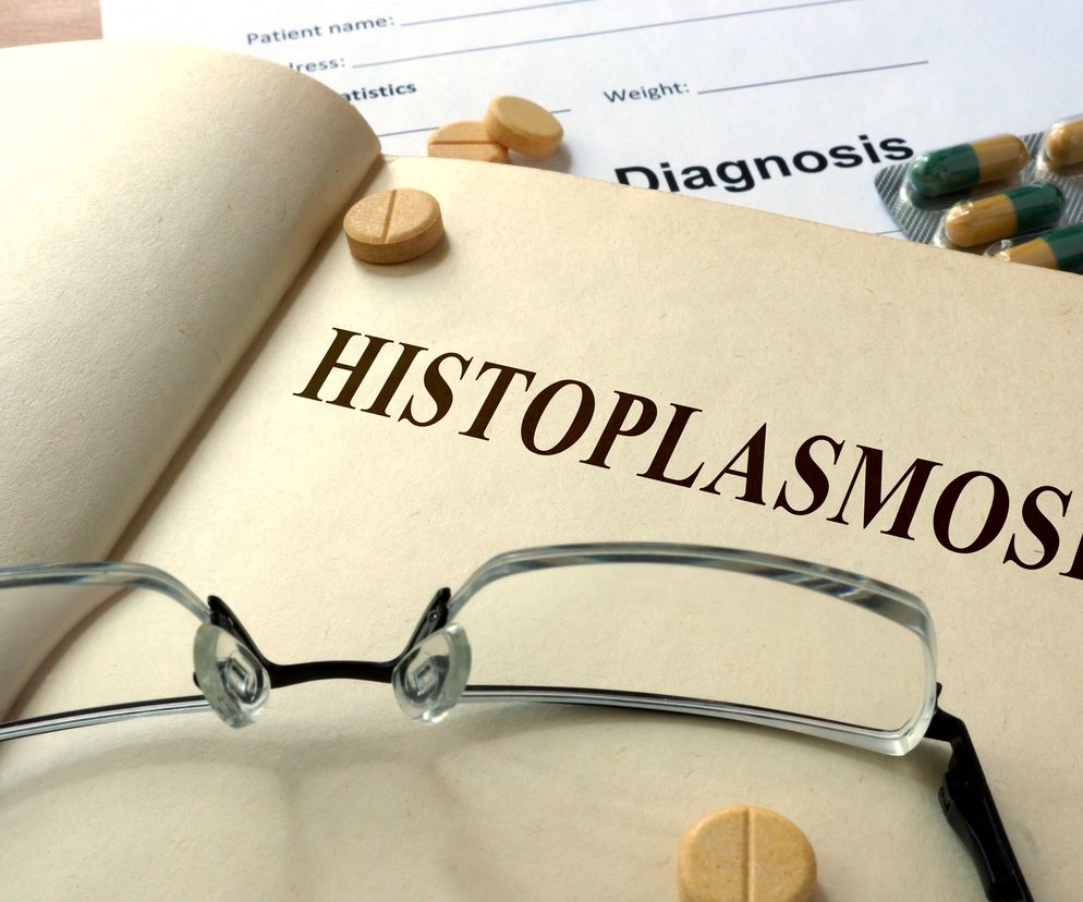 Histoplazmoza (choroba Darlinga): przyczyny, objawy,leczenie