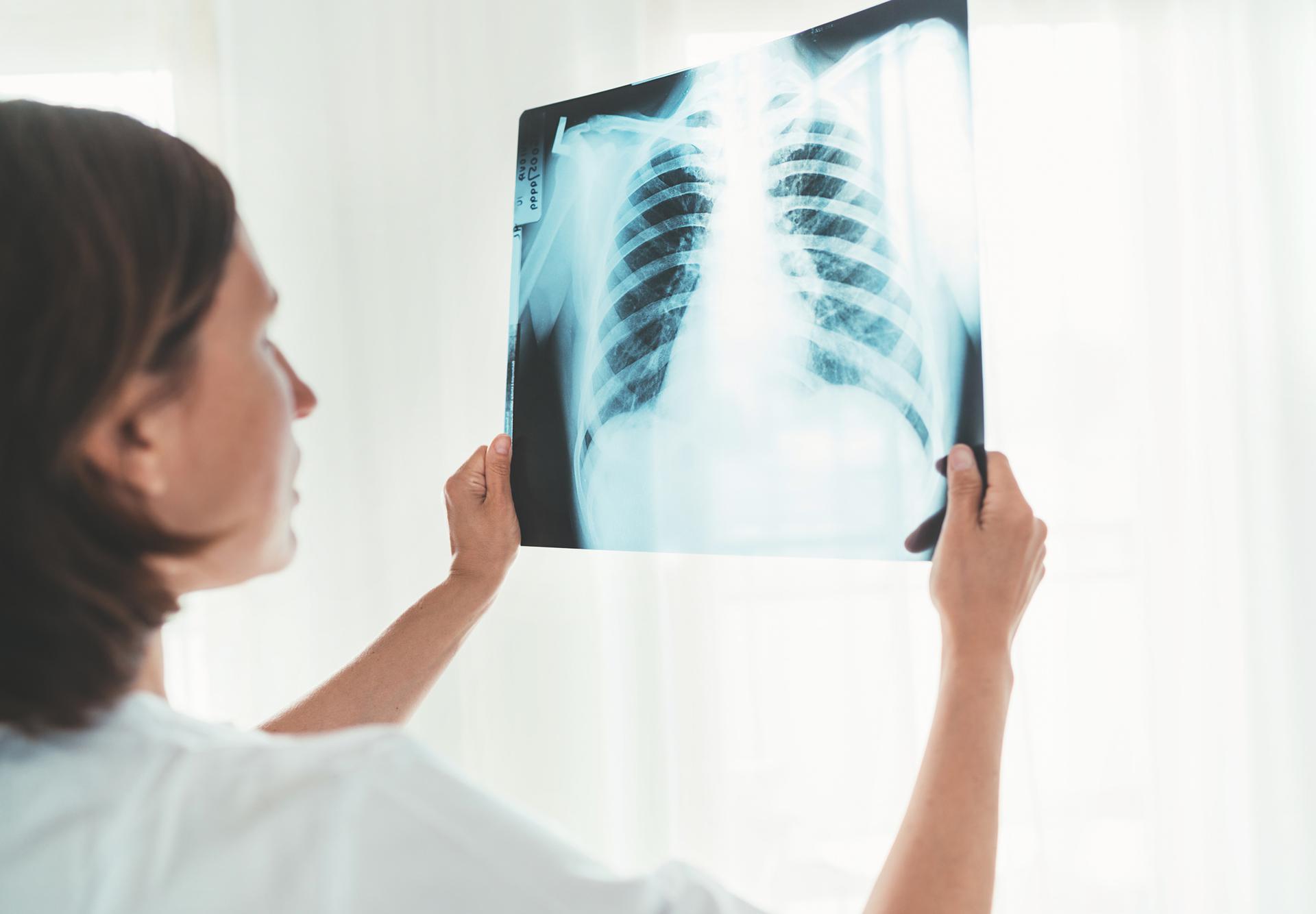 Рентген грудной клетки больного человека