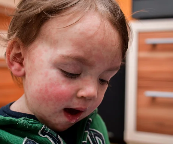 Ognisko odry na Podkarpaciu. 11 osób z potwierdzonym zakażeniem