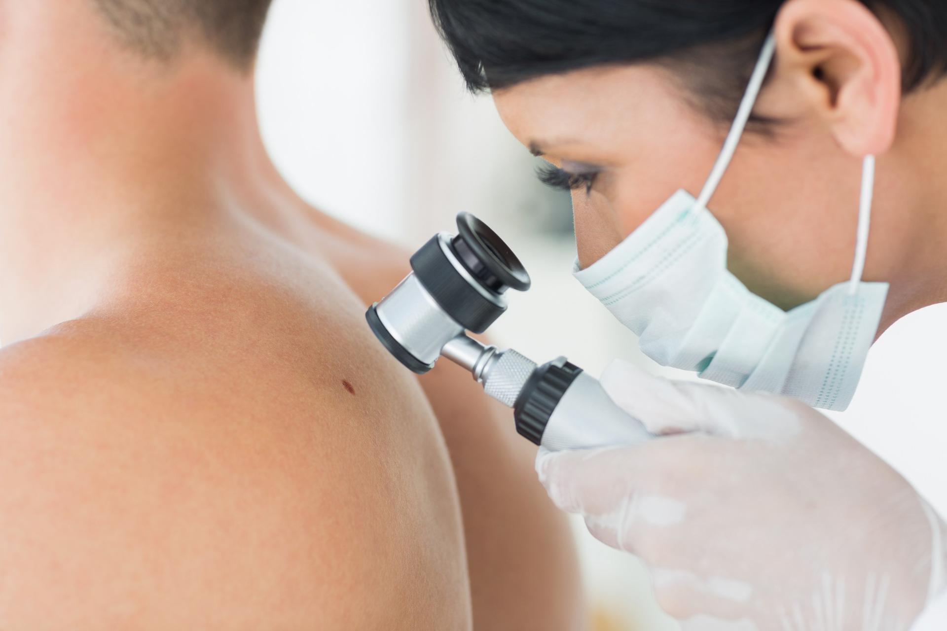 Dermatoskopia - badanie znamion dermatoskopem - PoradnikZdrowie.pl