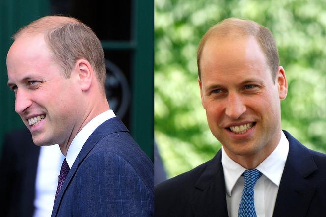 To najczęstsza przypadłość mężczyzn. Książę William przeszczepi włosy?