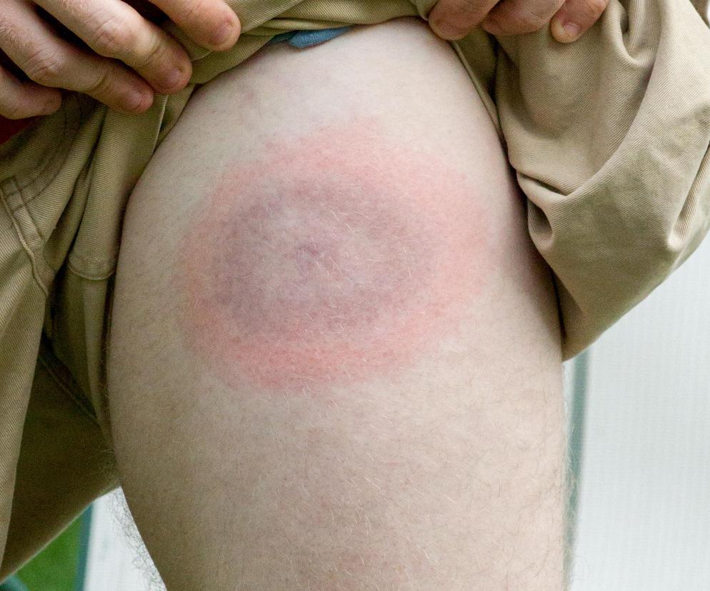 Kontrowersyjna metoda ILADS ma leczyć, a może szkodzić. Stanowi istotne ryzyko