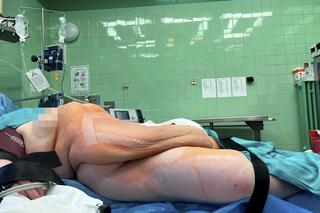 Wycięli pacjentce 100 kg guza