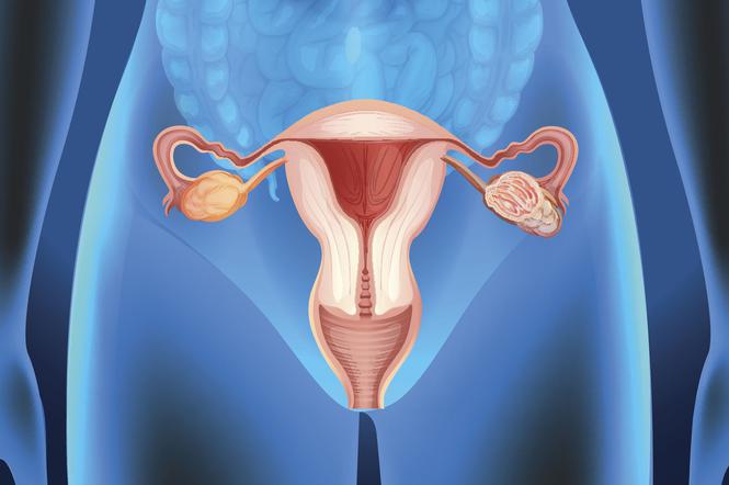Zespół policystycznych jajników – nieleczony może prowadzić do raka błony śluzowej macicy