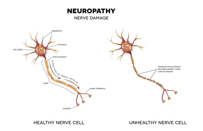 Neuropatia: rodzaje, przyczyny, objawy, leczenie