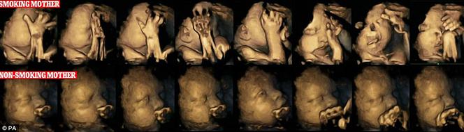 Szokujące zdjęcia dziecka rozwijającego się w łonie palaczki! Czym różni się od zdrowego dziecka?   