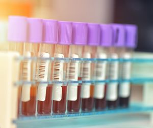 Hipercholesterolemia - przyczyny, objawy, leczenie hipercholesterolemii