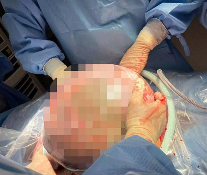 Ogromny guz jajnika usunięty w Centrum Onkologii w Bydgoszczy