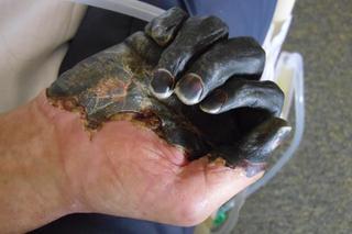 Ręce zaatakowane gangreną