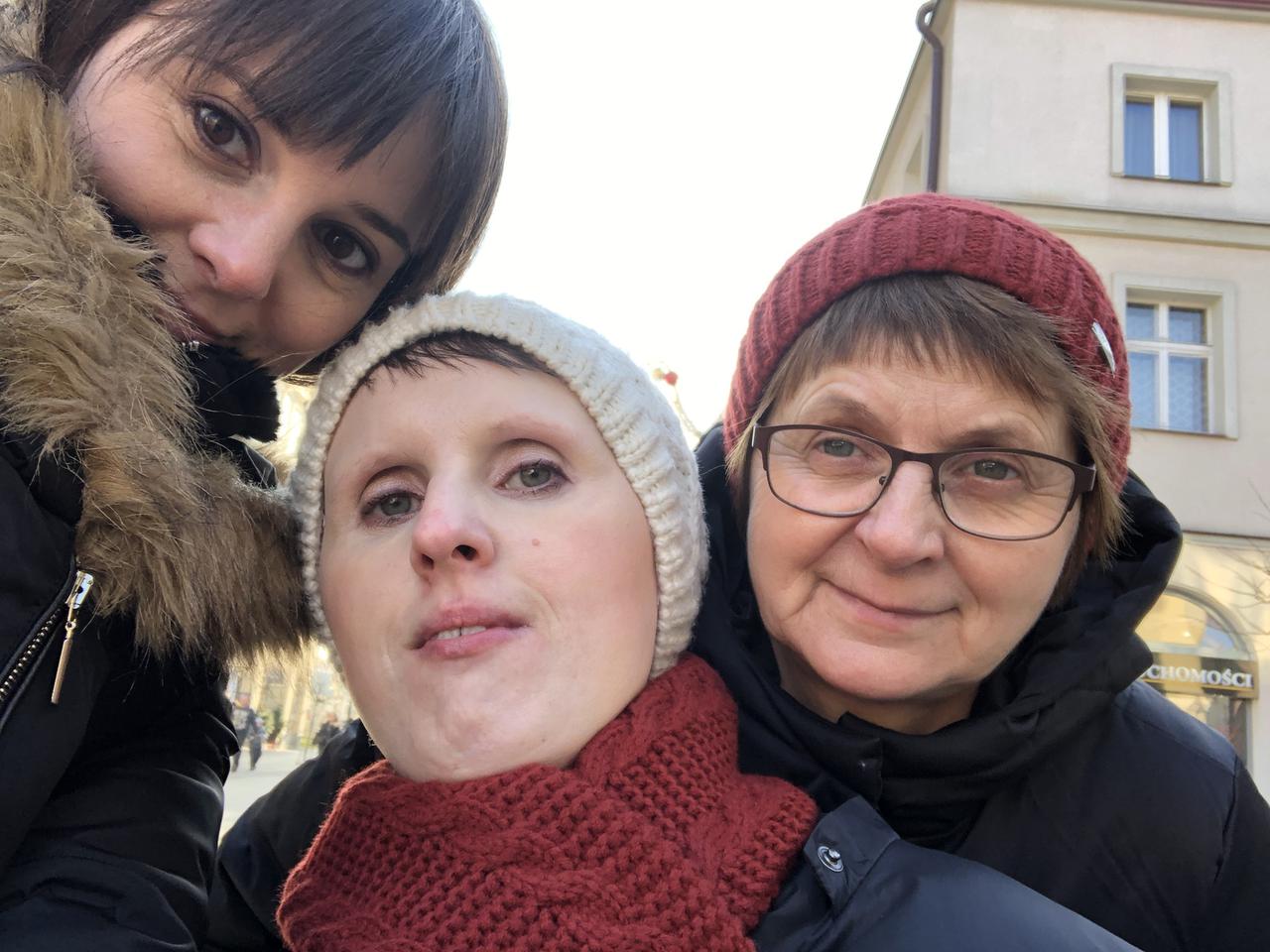 Żyję z fibrodysplazją. Moje ciało staje się żywym posągiem