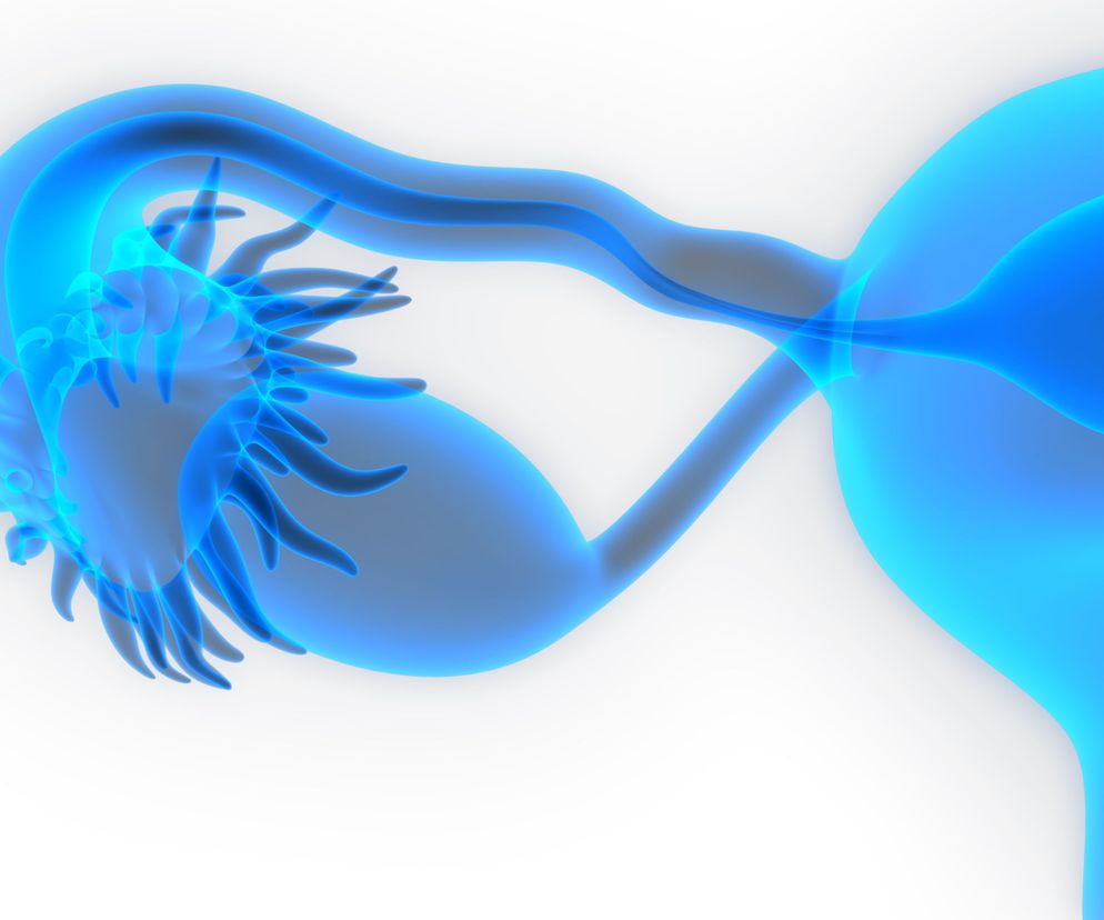 Kauteryzacja jajników to jedna z form postępowania terapeutycznego w przypadku pacjentek cierpiących na zespół policystycznych jajników (PCOS).