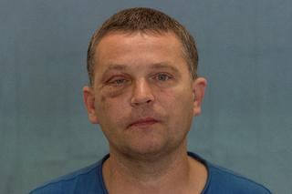 Wydrukowali mu nowe kości twarzy