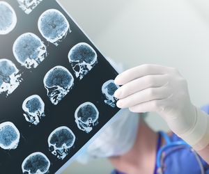 Udar móżdżku daje bardzo nietypowe objawy. Dowiedz się, jak go rozpoznać