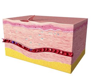 Nerwiakowłókniak – GUZ o charakterze nowotworu łagodnego