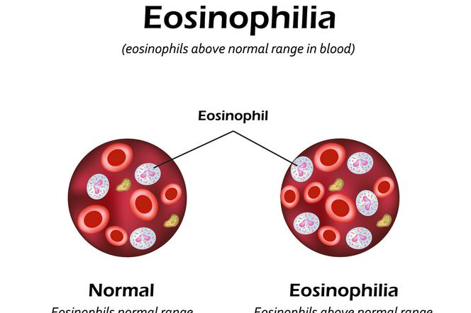 Eozynofilia: rodzaje i przyczyny
