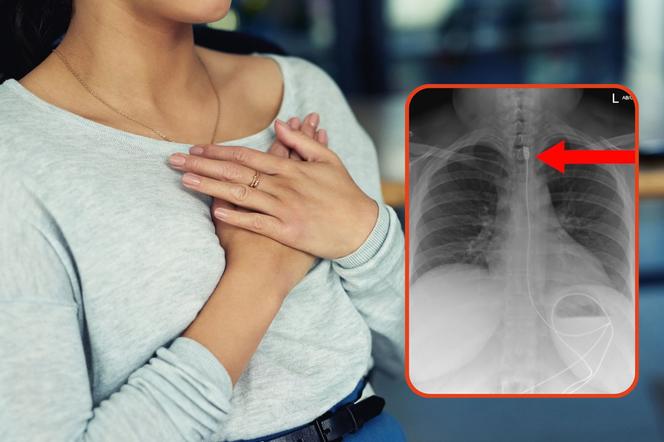 Trafiła na SOR z metrowym kablem w przełyku. Lekarze zdiagnozowali rzadkie zaburzenie