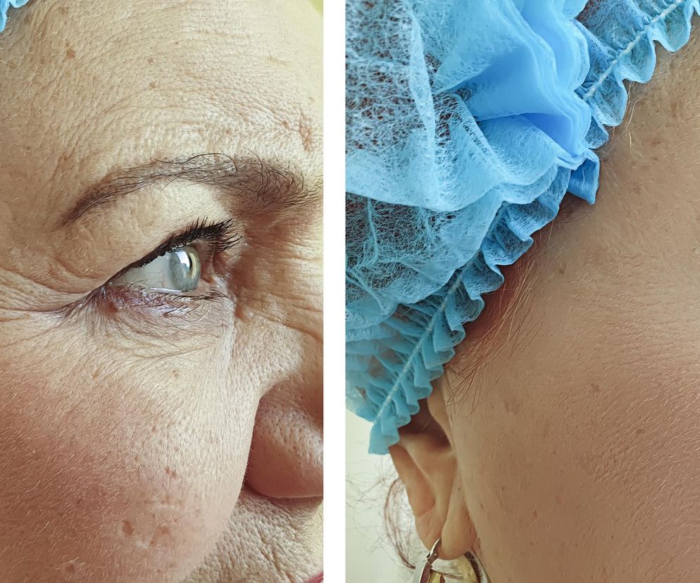 Kosztuje 5 złotych, a działa jak botoks pod oczy. Posmaruj i zostaw na 30 minut