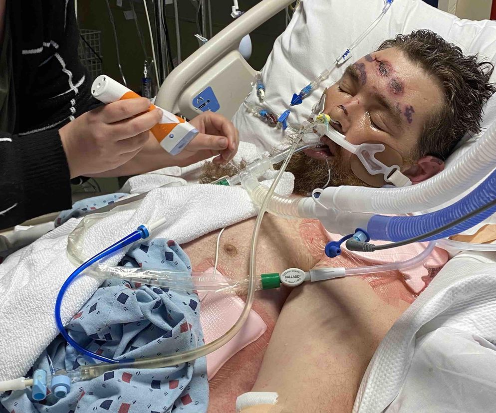 Chciał wyrwać włos, trafił na OIOM. Lekarze dawali mu 4 proc. szans na przeżycie