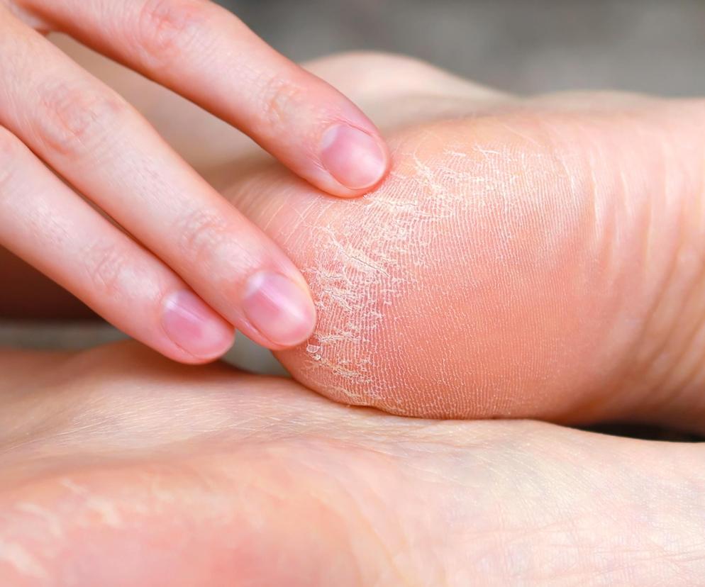 W gorące dni chodzisz w klapkach? Możesz sam sobie robić pod górkę