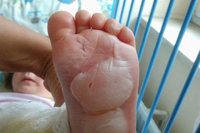 2-latka weszła na rozgrzany właz i poparzyła swoje stopki