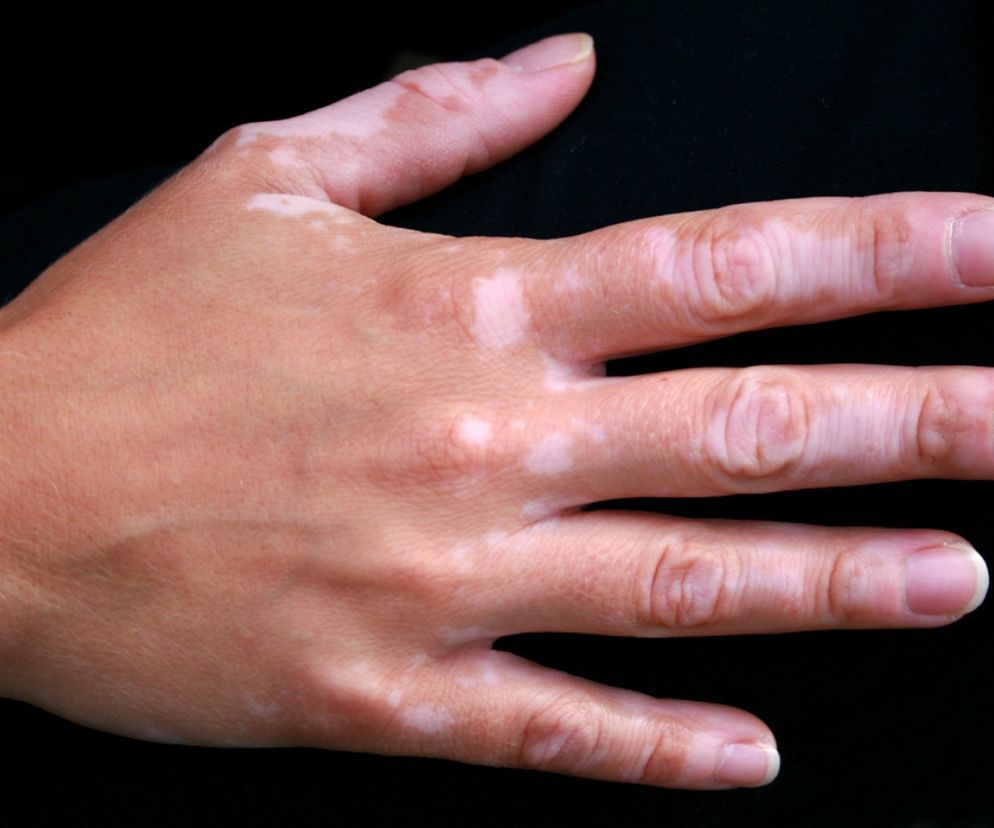 Bielactwo potrzebuje słońca