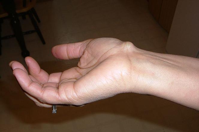 Ganglion to guzek na nadgarstku