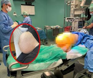 Lekarze ze szpitala Latawiec usunęli gigantycznego guza 38-letniej pacjentce