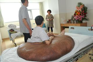 Mężczyzna z gigantycznym guzem! Narośl ważyła 107 kilogramów!