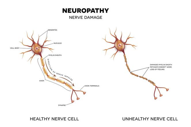 Neuropatia: rodzaje, przyczyny, objawy, leczenie