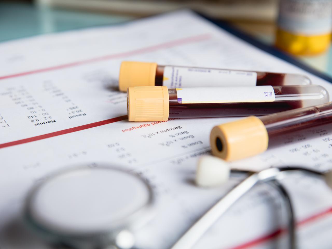 Niedokrwistość aplastyczna – objawy, typy i leczenie niedokrwistości aplastycznej