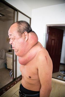 Mężczyzna z wielką szyją