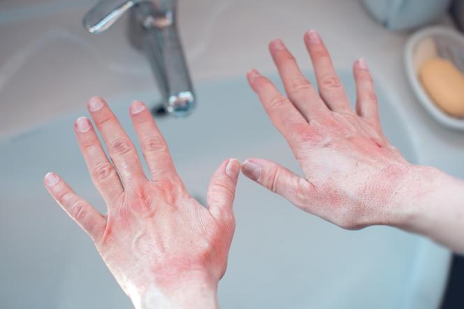 czerwone dłonie z chorobą skóry nad zlewem