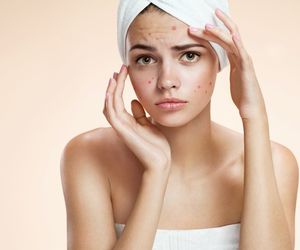 7 skutecznych metod walki z pryszczami