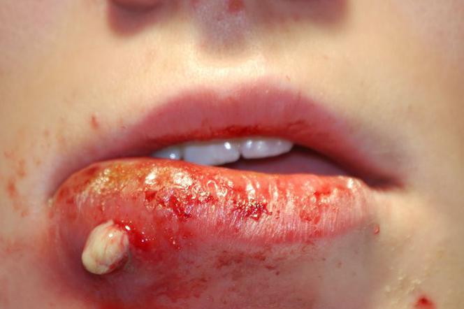 Zakażenie gronkowcem złocistym